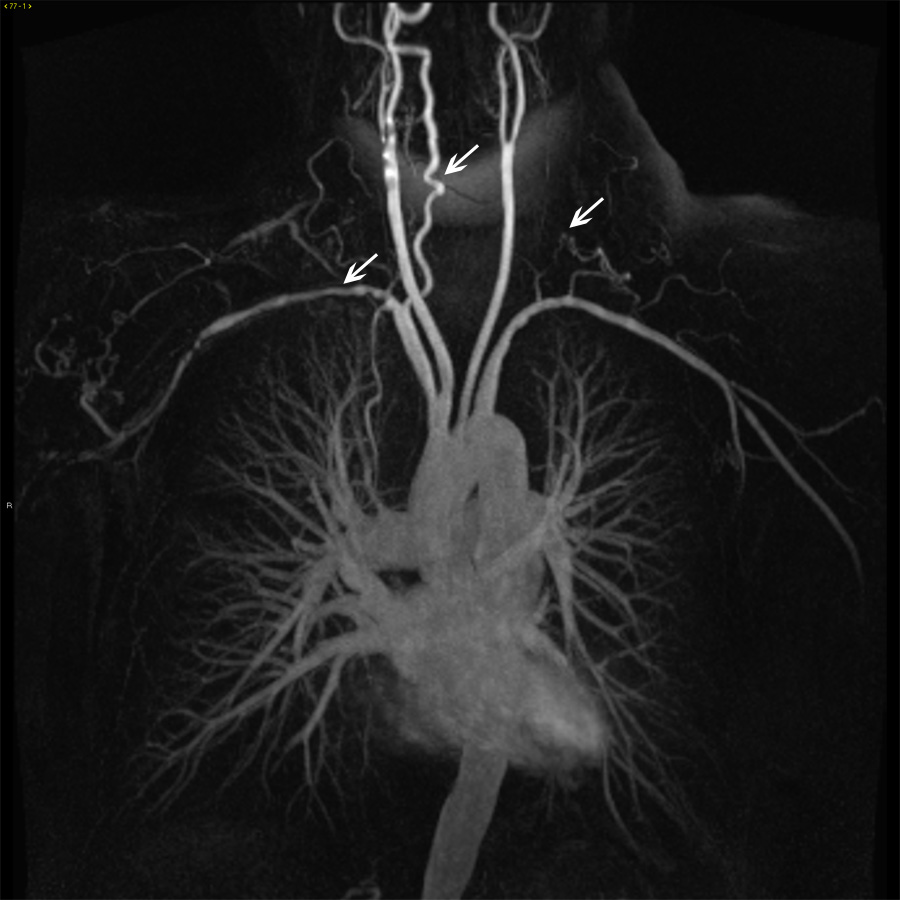 https://www.msdmanuals.com/-/media/manual/professional/images/19a-images-of-aorta-in-takayasu-arteritis-ctisus.jpg؟thn=0&sc_lang=ar