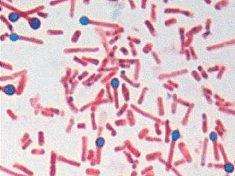 أ.  جراثيم وبكتيريا Clostridium tetani ذات الشكل النموذجي لعصا الطبل المعزولة من قشرة جروح إزالة القشرة في الحالة 1 (غرام-تلطيخ - 1000x). 