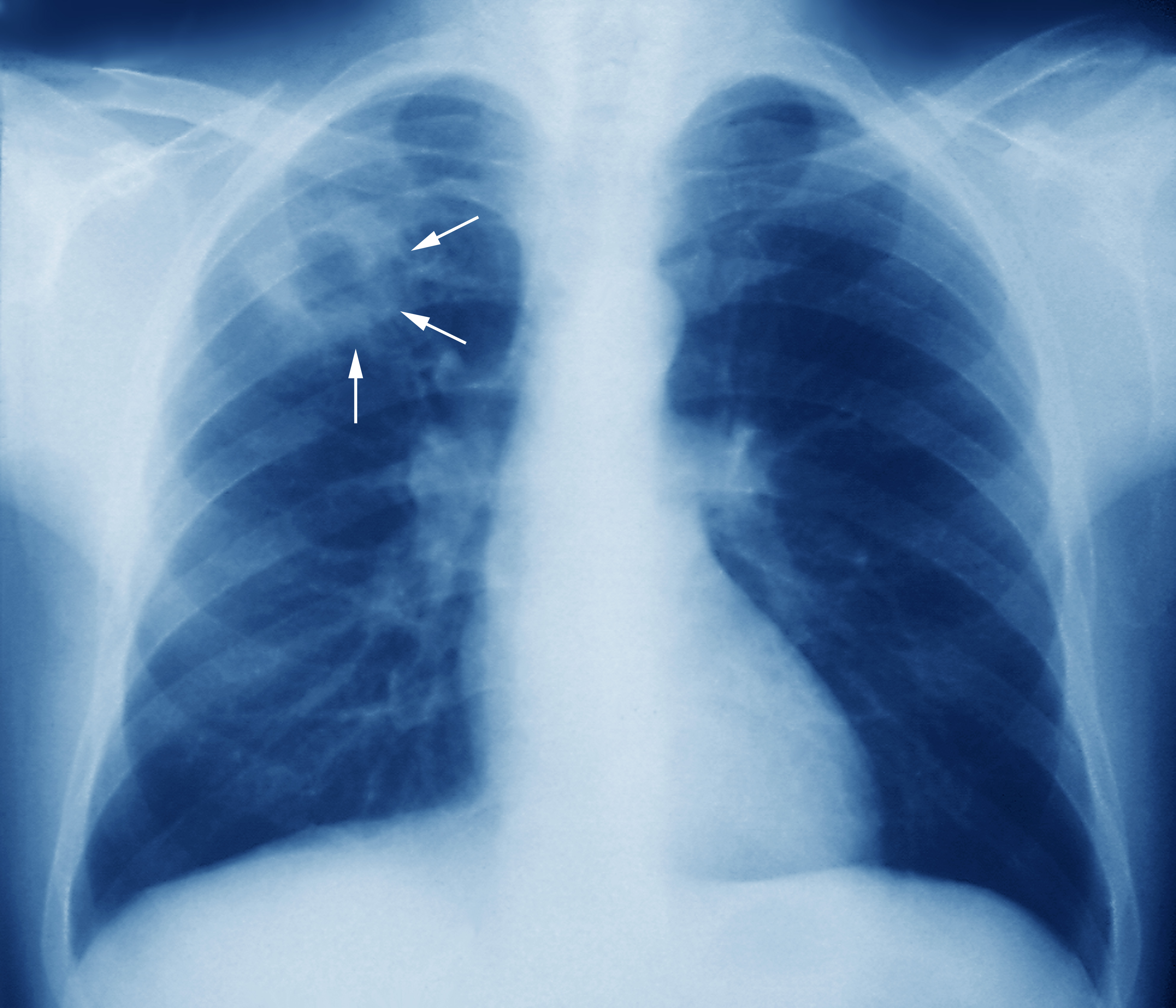 https://aldiwa.net/wp-content/uploads/2020/12/m2700245-tuberculosis-chest-x-ray-science-photo-library-high.jpg