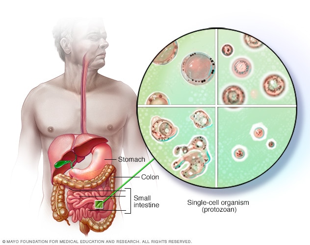 Blastocystis hominis - الأسباب والأعراض والعلاج