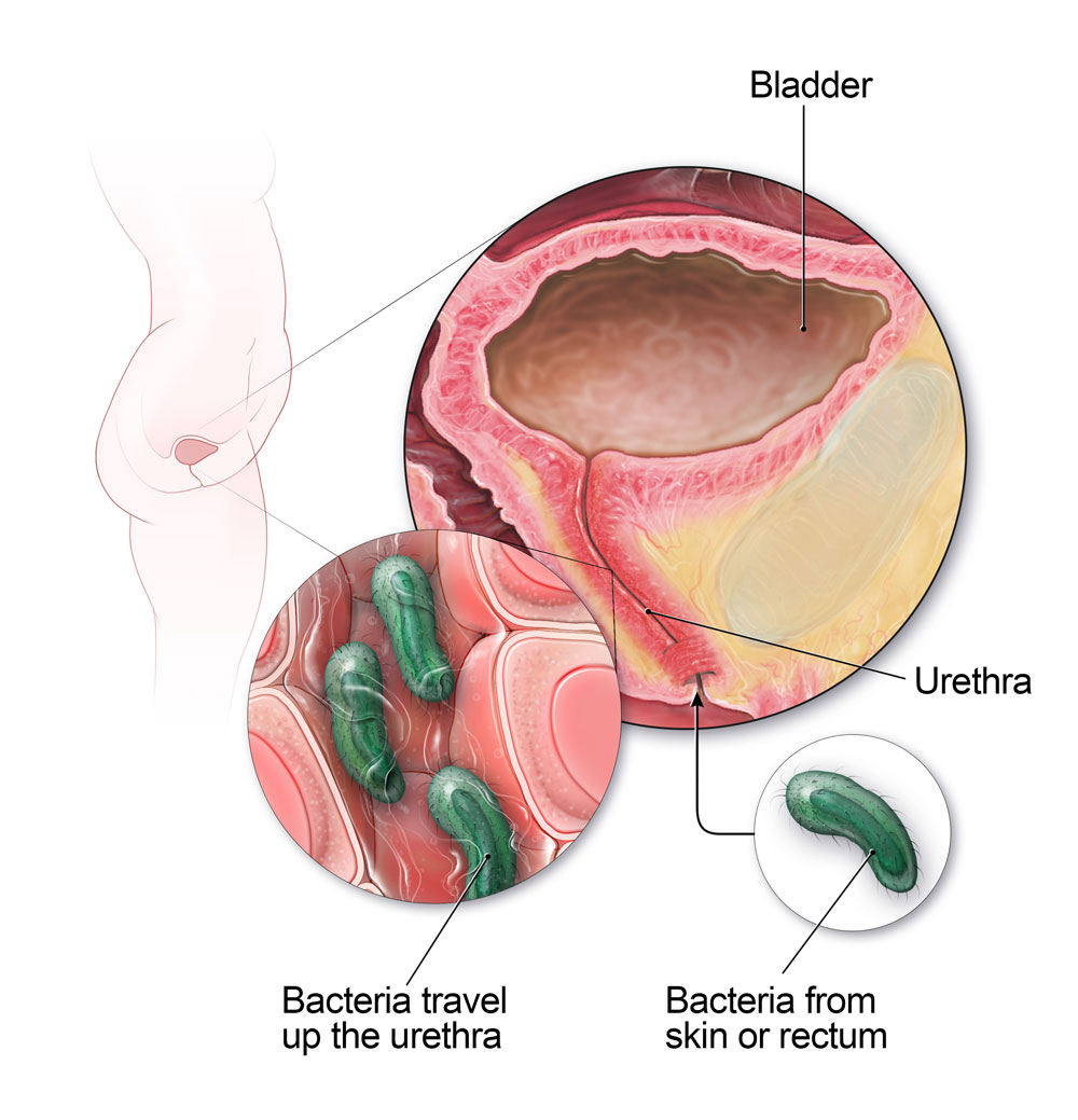 في الإناث ، يمكن أن تنتقل البكتيريا من الجلد أو المستقيم إلى مجرى البول وتسبب التهاب المثانة.
