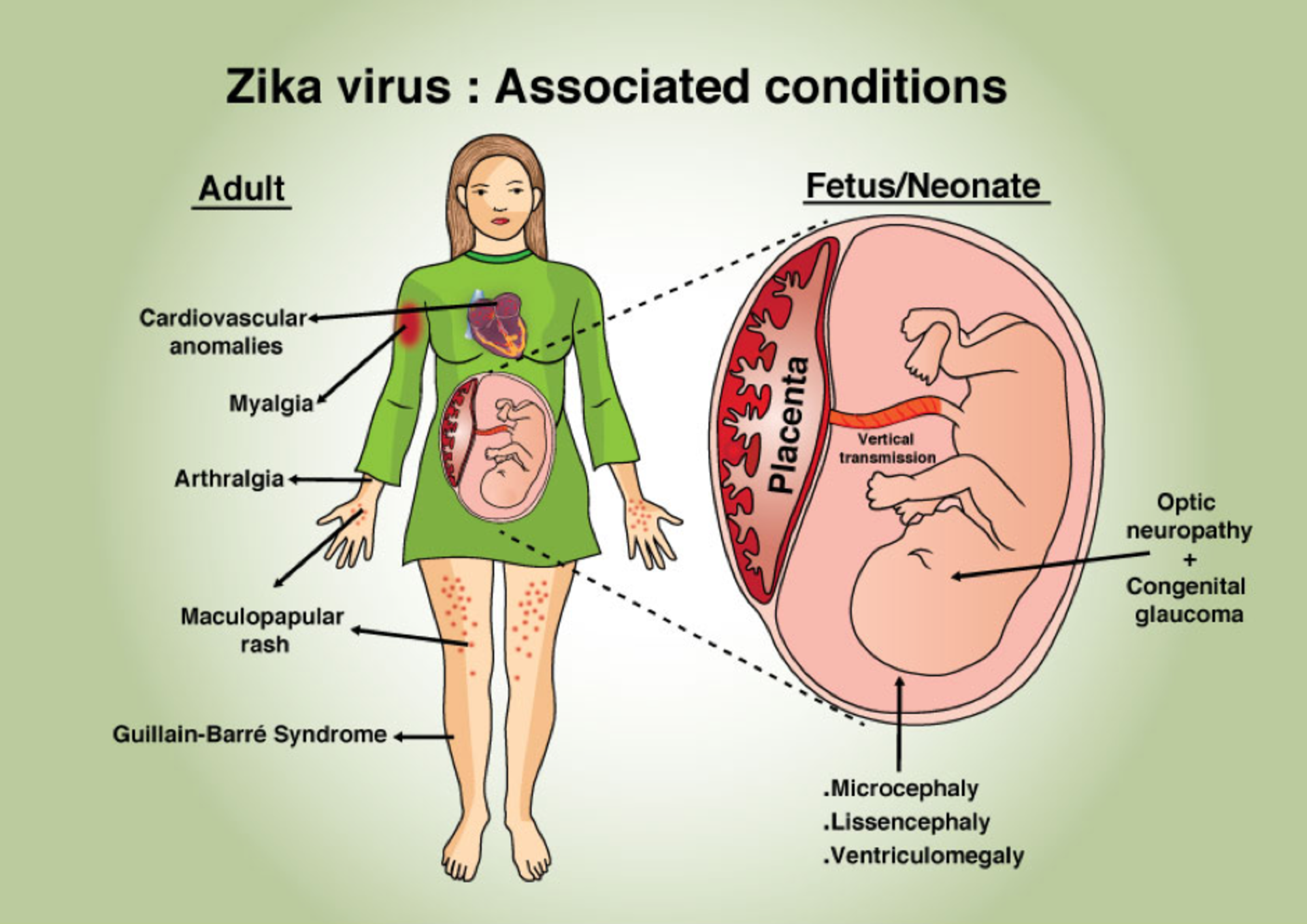 مضاعفات عدوى فيروس زيكا