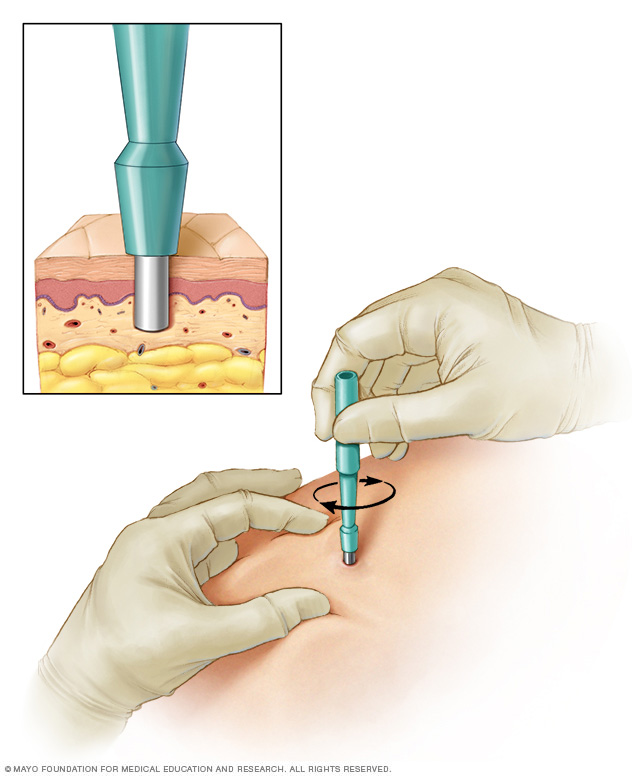 يستخدم الطبيب شفرة دائرية خاصة لإزالة الطبقات العميقة من الجلد للاختبار.  اعتمادًا على الحجم ، قد تكون الغرز ضرورية لإغلاق الجرح.